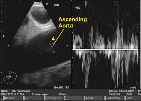 Techniques Of Linear Endobronchial Ultrasound Intechopen