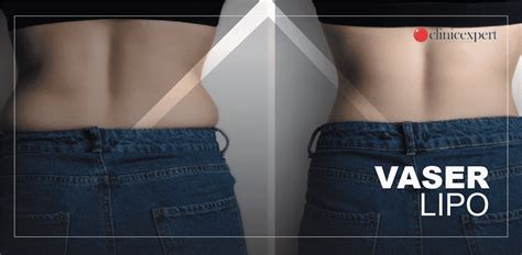 Vaser Lipo Before And After | ClinicExpert