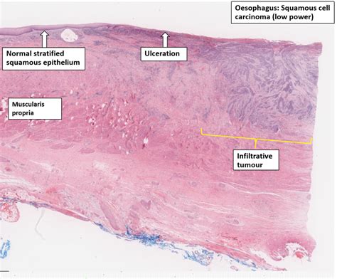 Oesophagus Squamous Cell Carcinoma Nus Pathweb Nus Pathweb