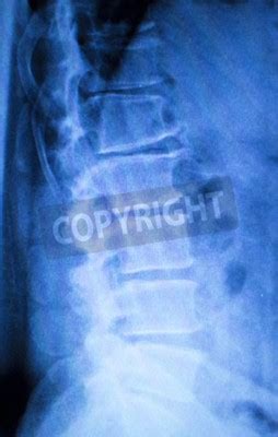 Dor No Pesco O E Coluna Vertebral X Ray Scan Traumatologia E Fotomural