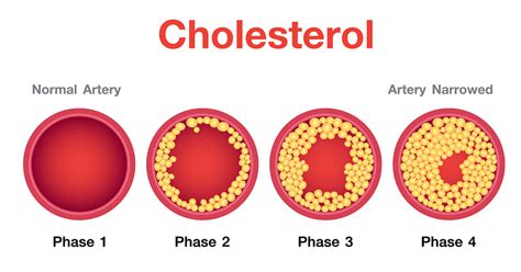 Causes Of High Cholesterol And Ways To Prevent It Setu Nutrition