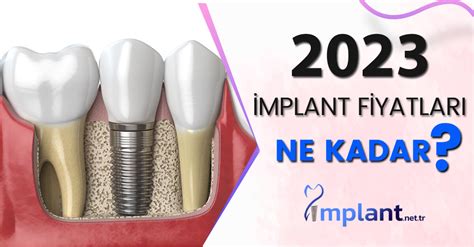 İmplant Fiyatları 2024 Ne Kadar Güncel İmplant Fiyatları