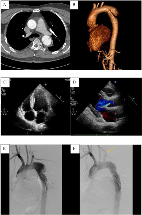 Diagnosis And Treatment Of Carotid Left Subclavian Bypass Graft Infection Complicated With