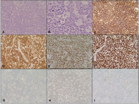 High Grade B Cell Lymphoma A Cellular Tumor With Monotonous Lymphoid Download Scientific