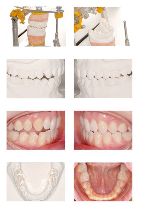 Acrylic Bite Planes For The Lower First And Second Molars Are