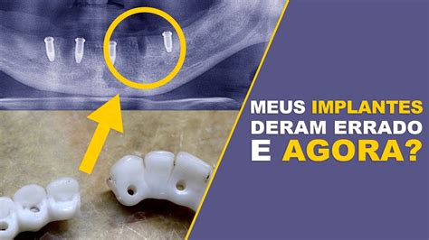 O Que Fazer Quando Implantes Dent Rios D O Errado Implace Implantes