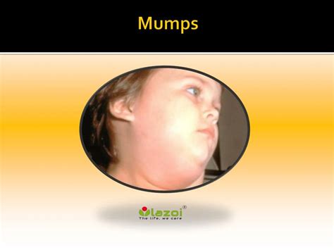 Ppt Mumps Causes Symptoms Daignosis Prevention And Treatment Powerpoint Presentation Id