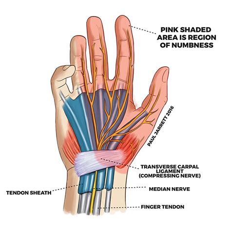 Carpal Tunnel Syndrome | VibroSense