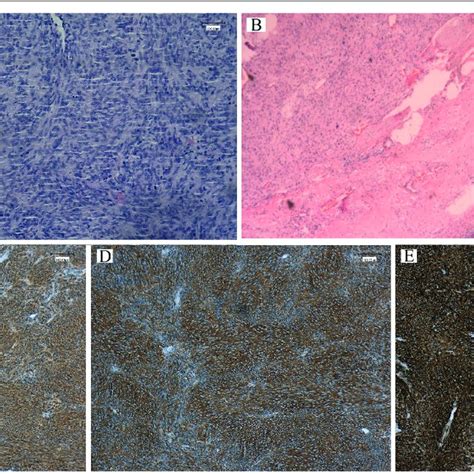 Histopathology Of The Biopsy Specimen A Histopathology Showed The