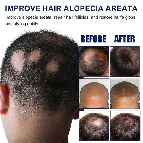 Scalp Anti-Dandruff and Antifungal Shampoo - Treats Folliculitis