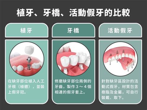 植牙後遺症解析：術前降低植牙副作用的3方法