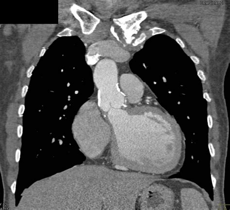 Calcification Of The Ascending Aorta Without Dissection Cardiac Case