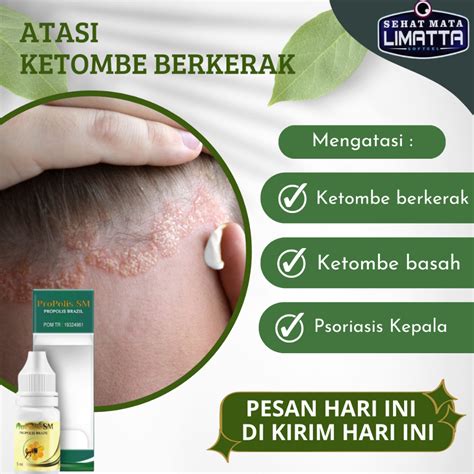 Jual Propolis SM Penghilang Infeksi Jamur Kepala Psoriasis Kulit