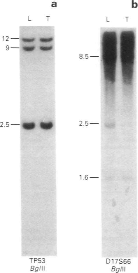 Loss Of Heterozygosity Loh Analysis Of High Grade Astrocytomas With Download Scientific