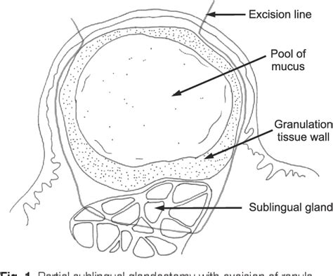 Figure 1 From Partial Sublingual Glandectomy With Ranula Excision A