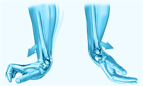 Dr Carlos Godoy Fracturas De Radio Distal