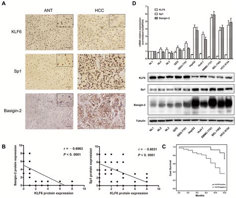 KLF6 Is Down Regulated In HCC Tissues And Cell Lines A IHC Analysis