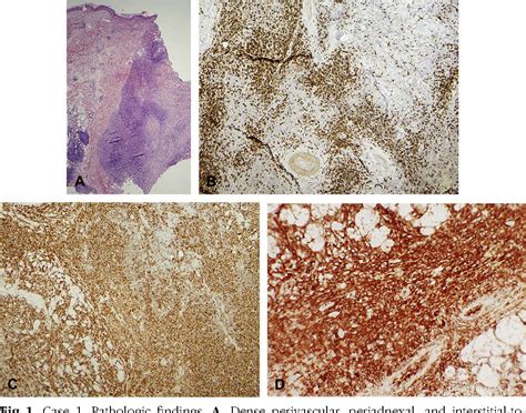 Figure 1 From Unusual Cutaneous Manifestations Of B Cell Chronic