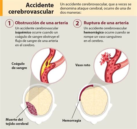 Consecuencias Psicol Gicas Del Acv Rehabilitaci N Y Tratamiento