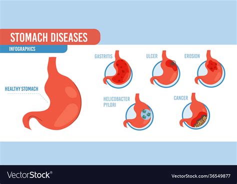 Flat Cartoon Infographic Stomach Diseases Vector Illustration Concept ...