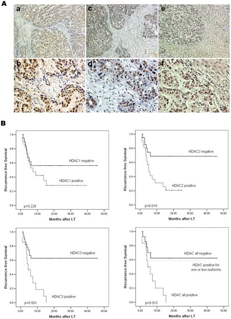 The Role Of Class I Hdac Expression In Hcc Patients Receiving Liver