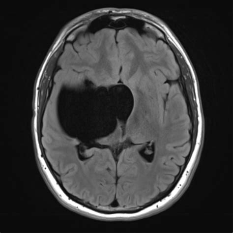 Suprasellar Arachnoid Cyst Massive Image