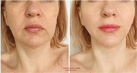 NON SURGICAL LIQUID FACELIFT WITH DERMAL FILLERS BROOKLYN NY Park