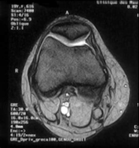 Patellofemoral instability in skeletally immature patients | Porto
