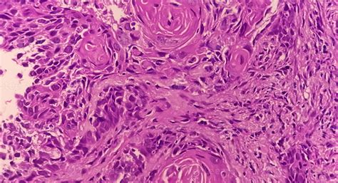 Photomicrograph Of Histological Slide Showing Lobular Capillary Hemangioma On Finger 43292572