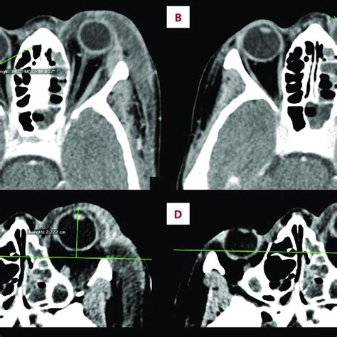 Computed Tomography Axial Sections A B Difference Between The