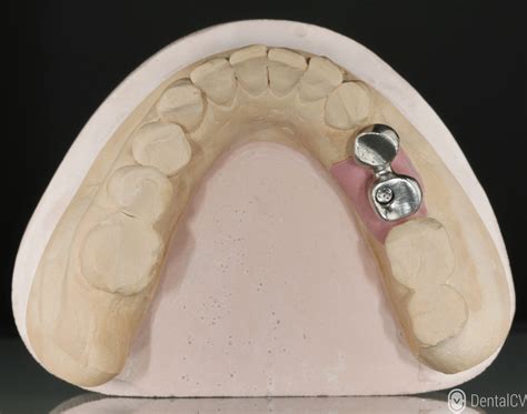 Pontes Sobre Implantes Tipo Cantilever Dental Cv