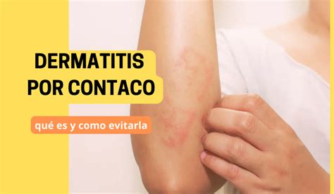 Dermatitis Por Contacto Especialistas