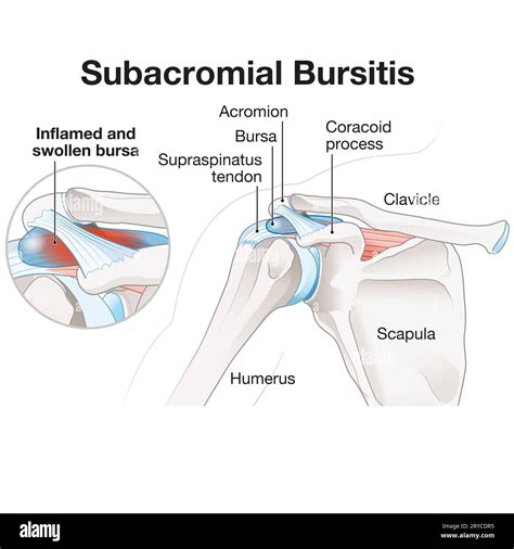 Subacromial Bursitis Is Inflammation Of The Bursa In The Shoulder