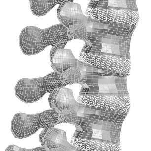 Finite Element Model Of The Intact Spine Left And The Fractured Spine