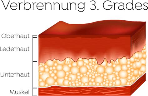 Verbrennungen Was Tun Octenisept