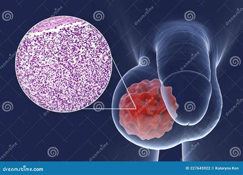 Testicular Cancer 3d Illustration And Light Micrograph Stock