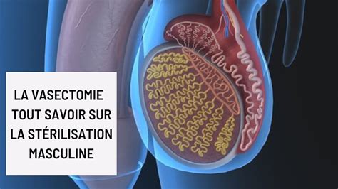 La Vasectomie Tout Savoir Sur La Stérilisation Masculine Youtube