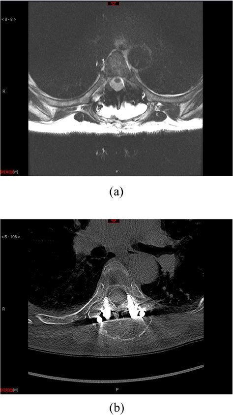 Non Instrumented Posterolateral Lumbar Fusion And Allograft The Spine