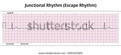 Ecg Junctional Rhythm Escape Rhythm 8 Stock Vector Royalty Free 2381222303 Shutterstock