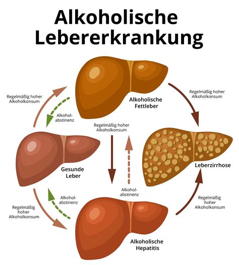 Was Ist Eine Alkoholische Hepatitis Und Wie Wird Behandelt