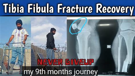 Tibia Fibula Fracture Recovery My 9th Months Journery The Road To