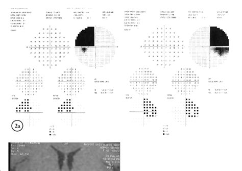 A A 43 Year Old Woman Who Presented With Right Sided Third Cranial Download Scientific Diagram