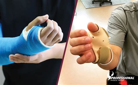 Scaphoid Fracture Cast Or Splint