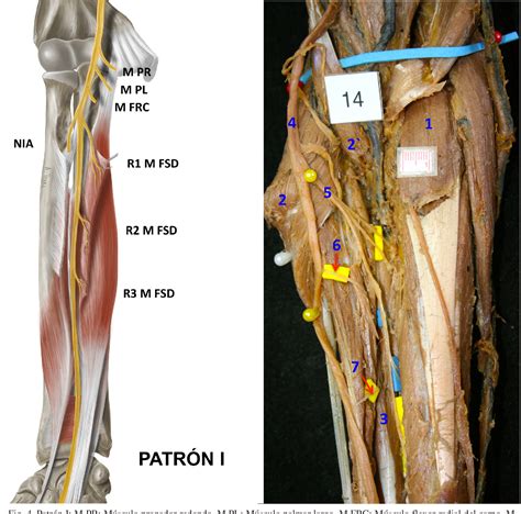 Figure 2 from Inervación del Músculo Flexor Superficial de los Dedos