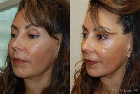 Eric M Joseph Md Non Surgical Rhinoplasty Before And After Bridge