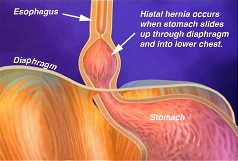 The Health Website Hiatus Hernia