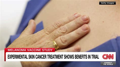 Experimental Melanoma Vaccine Combined With Immunotherapy Continues