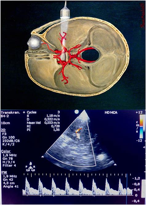 Frontiers Transcranial Doppler During The First Week After Cardiac