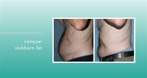 Pin On Laser Liposuction San Diego