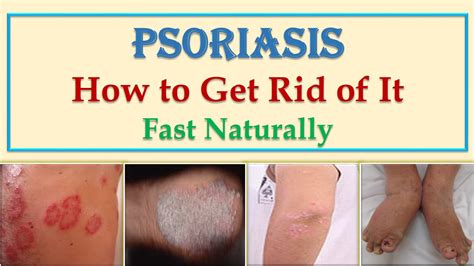 Best Natural Home Remedies And Cures For Scalp And Skin Psoriasis Treatment Youtube